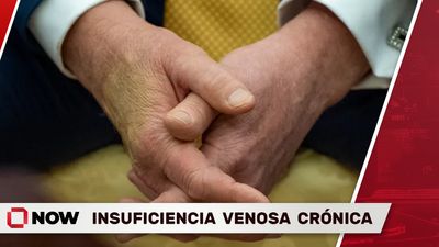 Trump Diagnosticado con Insuficiencia Venosa Crónica